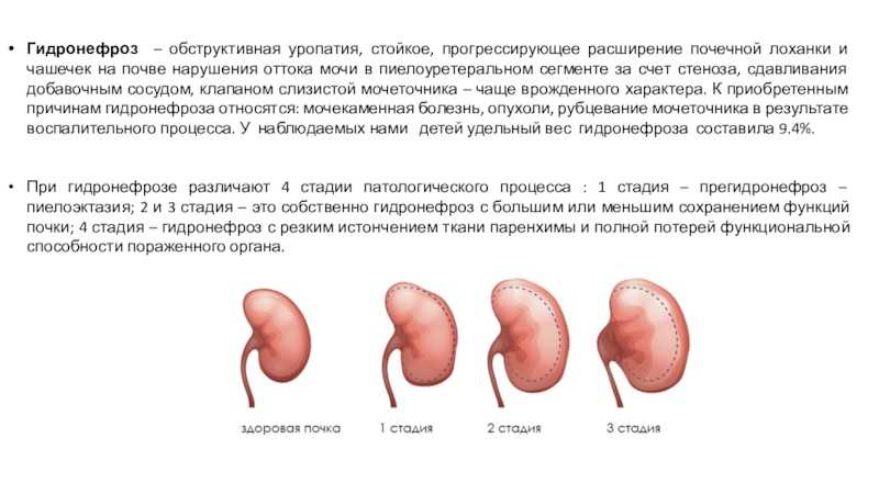 Киста почки - клиника 29