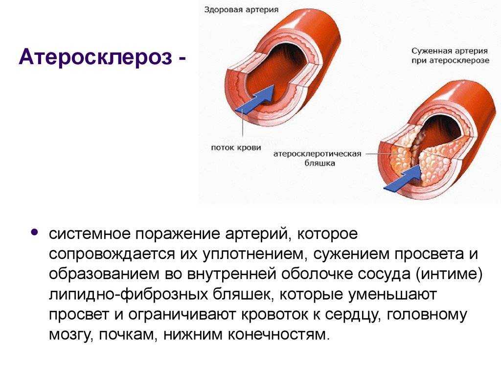 Какое давление при атеросклерозе. Атеросклеротического поражения стенок кровеносных сосудов. Атеросклеротическое поражение артерий. Атеросклеротические изменения сосудов. Атеросклероз это изменение кровеносных сосудов.