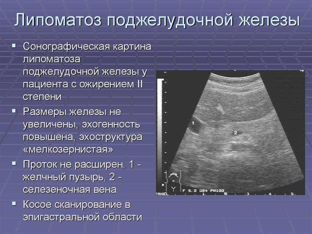 Стеатопанкреатит. что такое, причина, диагностика и лечение стеатопанкреатита!