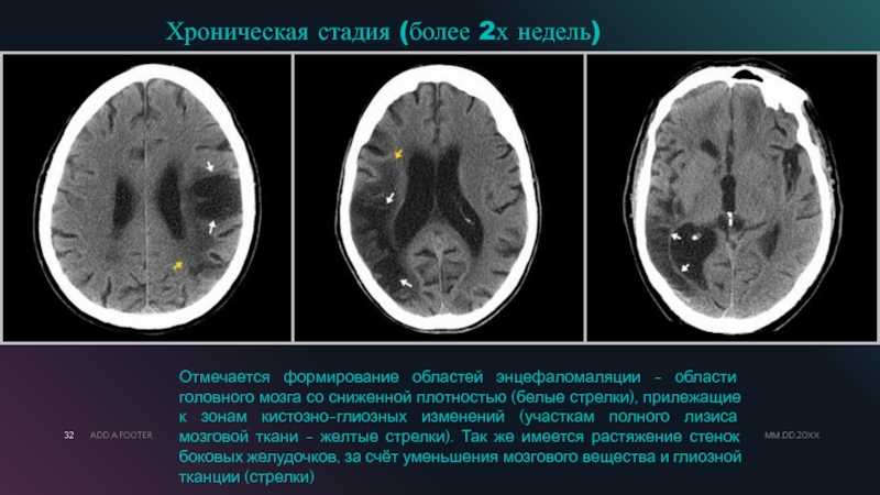 Глиоз в лобной доле головного мозга. Ишемический инсульт на кт головного мозга плотность. Глиозные изменения головного мозга на кт. Кистозно-глиозные изменения на кт. Кистозно-глиозные изменения головного.