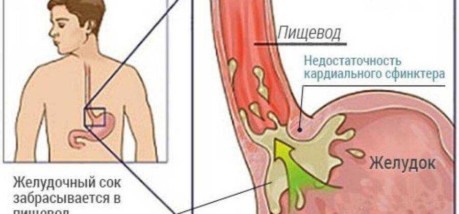 Чем лечить недостаточность кардии желудка препараты схема