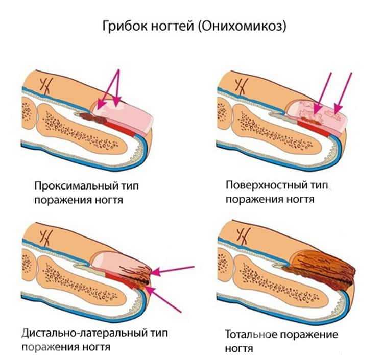 Онихомикоз ногтей схема лечения препараты