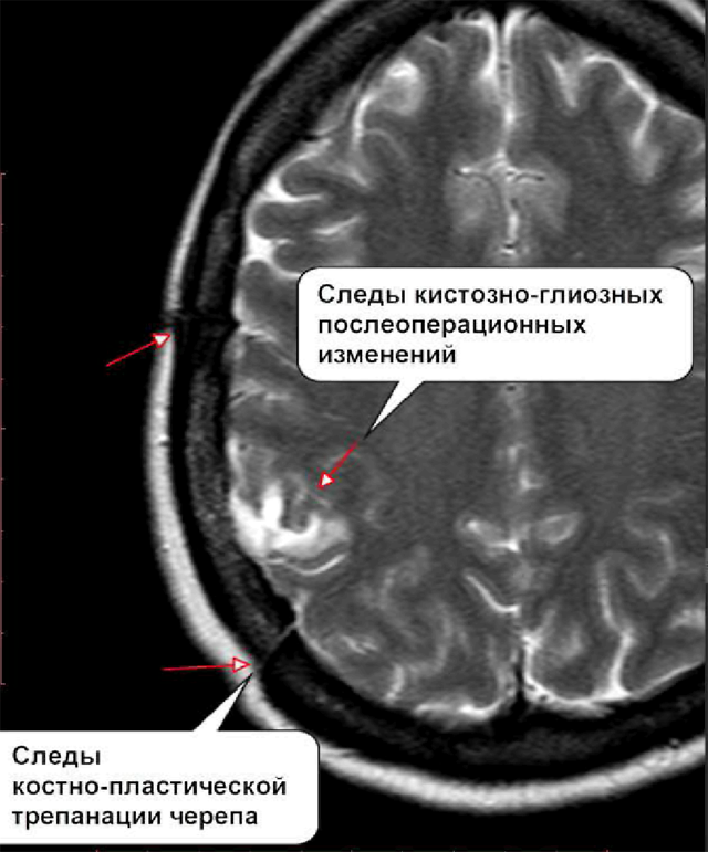 Глиоз