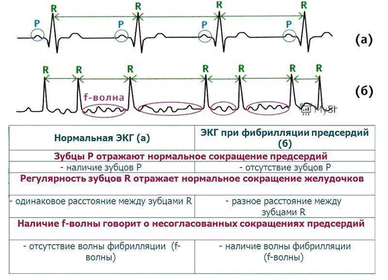 Пароксизм фибрилляции предсердий карта вызова скорой медицинской помощи