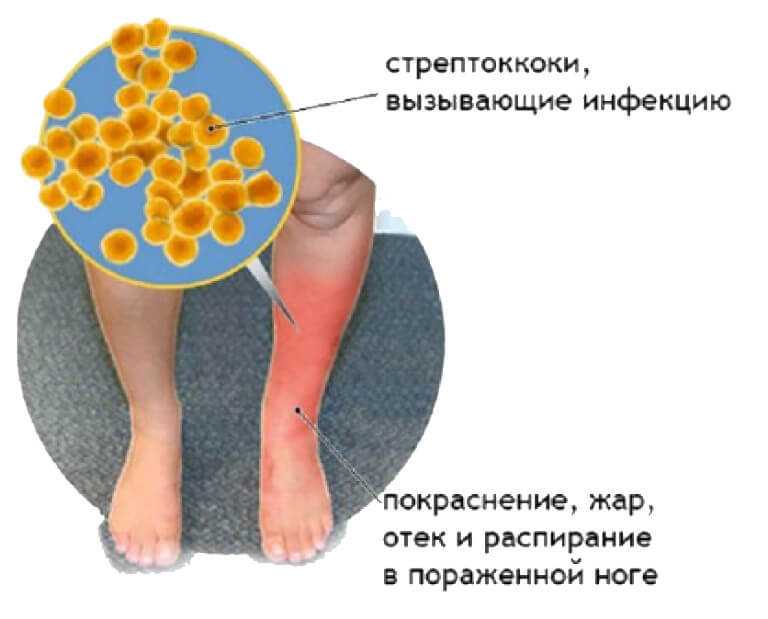 Рожа у детей - симптомы болезни, профилактика и лечение рожи у детей, причины заболевания и его диагностика на eurolab
