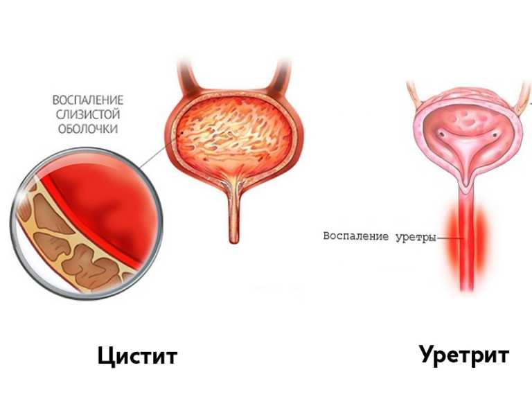 Боли при мочеиспускании