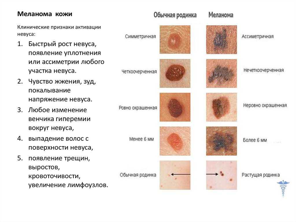 Меланома кожи: признаки, симптомы, начальная стадия