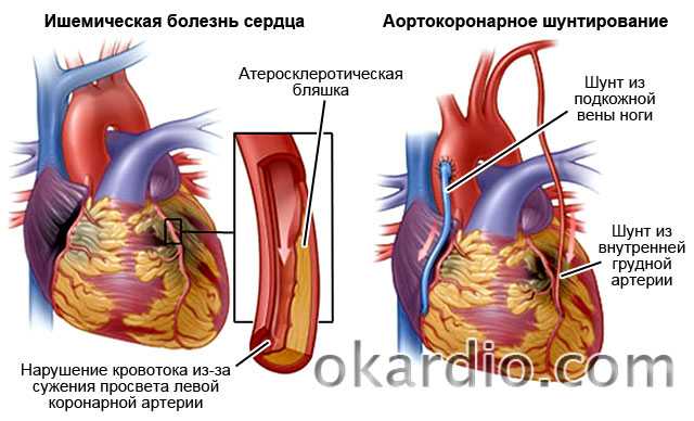 Интервью с доктором вадимом бережным об аорто-коронарном шунтировании