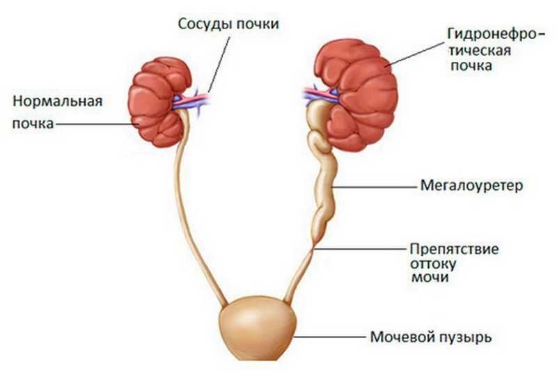 Гидронефроз клиническая картина