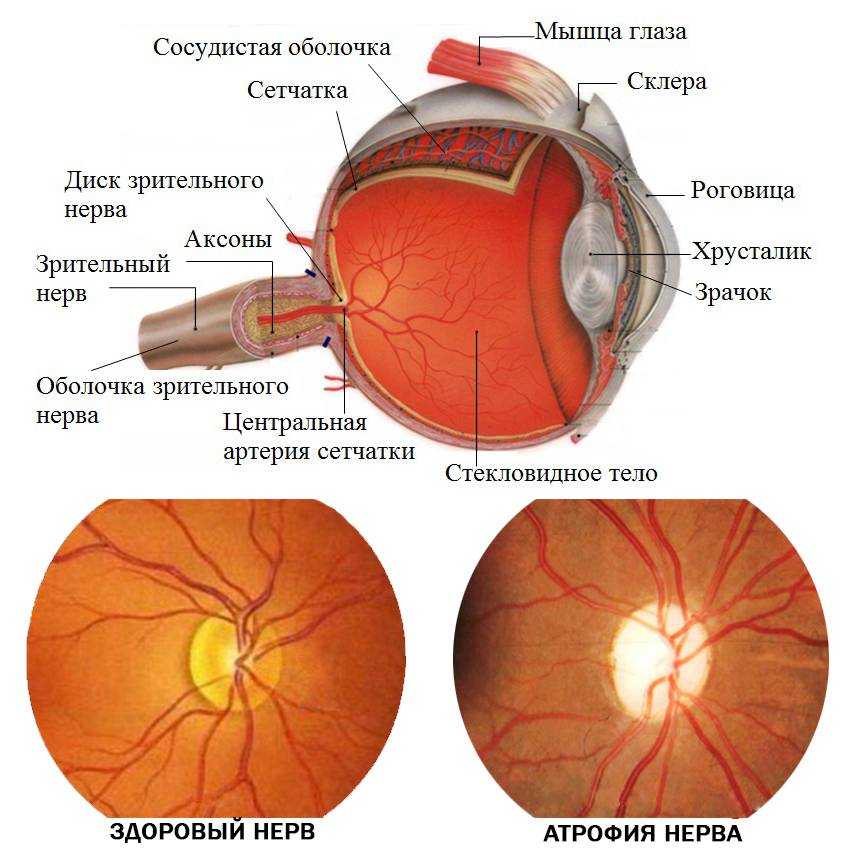 Заболевания зрительного нерва презентация