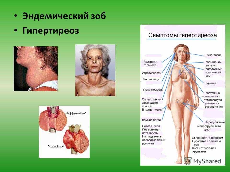 Зоб щитовидной железы – диагностика, лечение в международной клинике медика24