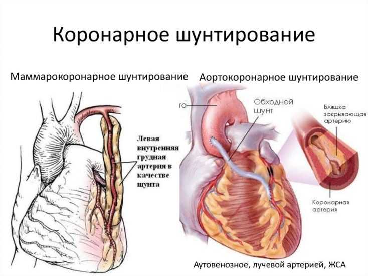 Коронарное шунтирование сосудов сердца – операция