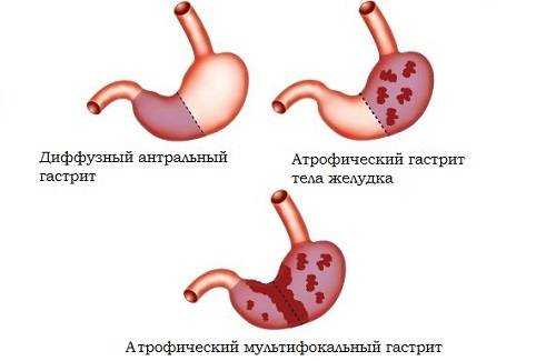Гастрит