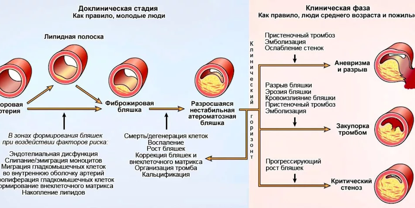 Заболевание периферических артерий и вен: тромбозы, варикоз, аневризмы