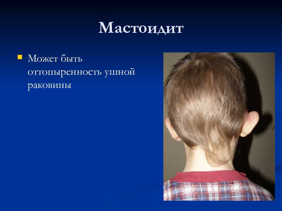 Мастоидит - симптомы и лечение