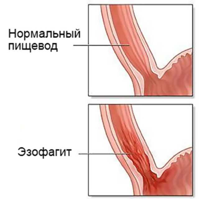 Диета при гастрите