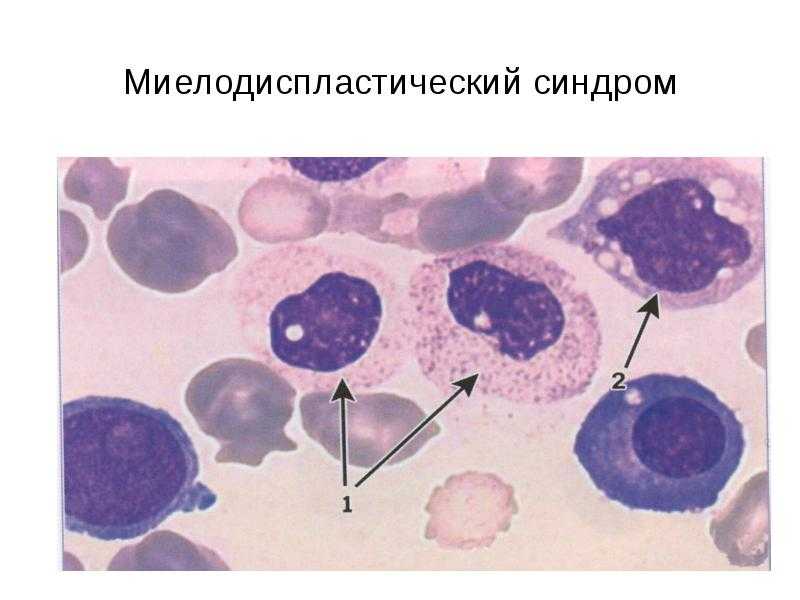 Уровень тромбоцитов в крови повышен: что это значит и что делать
