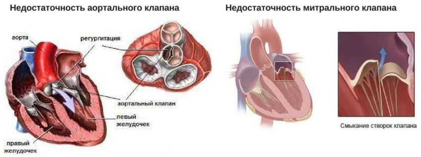 Митральная недостаточность: развитие, симптомы, диагностика, как лечить, прогноз