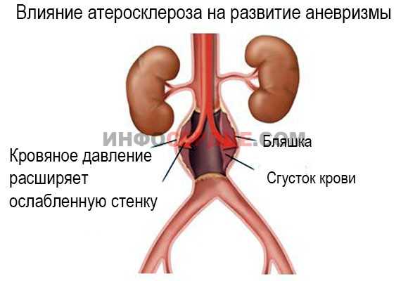 Заболевание периферических артерий и вен: тромбозы, варикоз, аневризмы