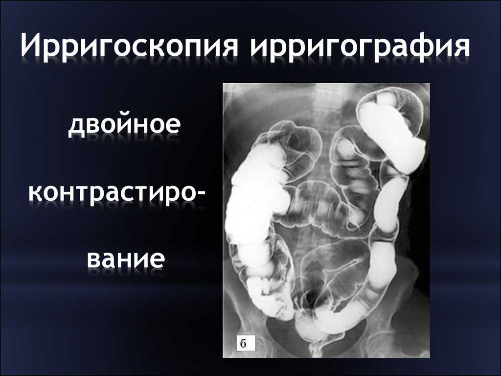 Ирригоскопия это рентгенологическое контрастное. Ирригоскопия и ирригография. Ирригоскопия иригограмма. Ирригоскопия Толстого кишечника. Ирригография толстой кишки.