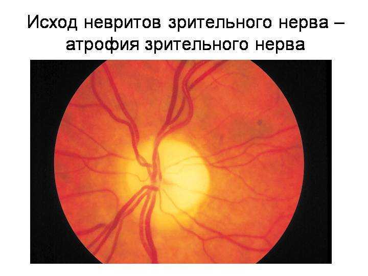 Лечение глазного нерва. Ретробульбарный неврит зрительного нерва. Папиллит зрительного нерва. Ретробульбарный неврит зрительного нерва глазное дно. Ретробульбарном неврите зрительного нерва.