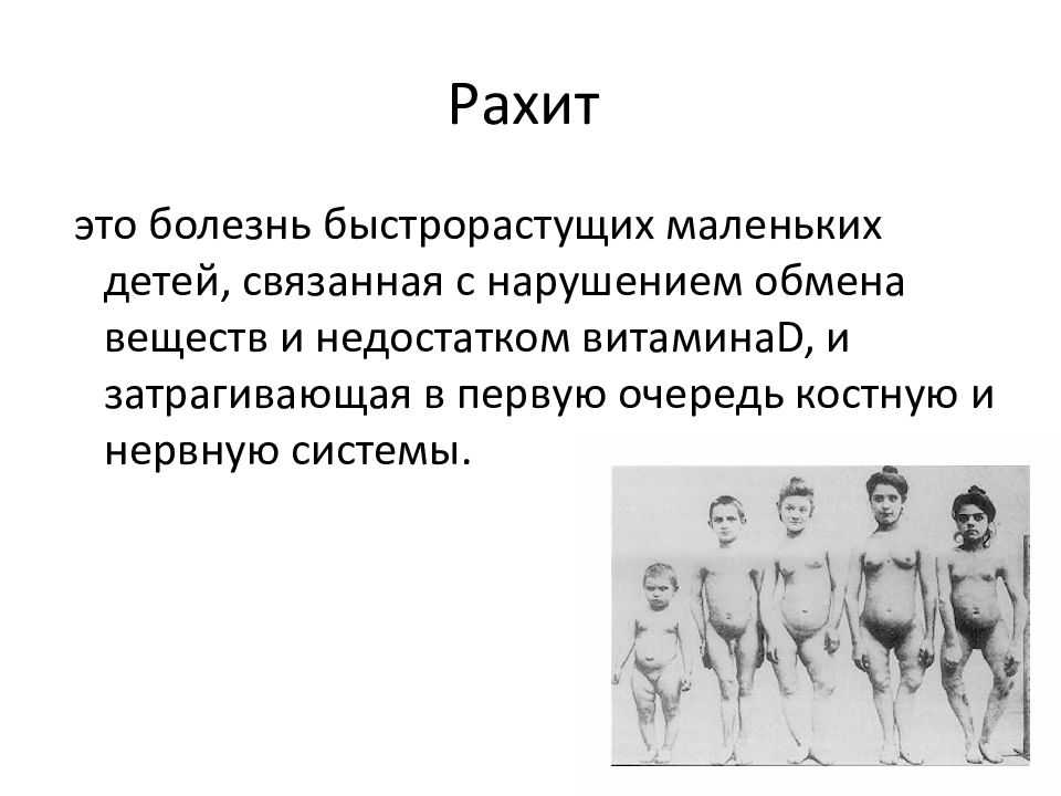 Рахит | статья в журнале «молодой ученый»
