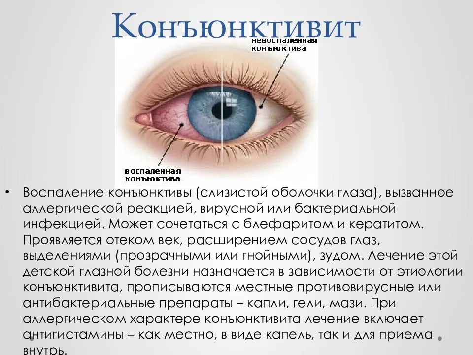 Скарлатина: что нужно знать всем родителям