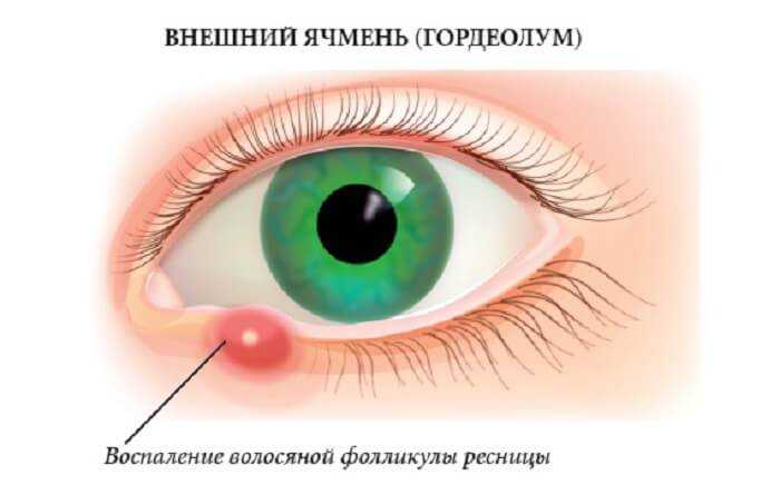 Белая точка на нижнем веке У ребёнка появилась в глазу (получается на MedAboutMe