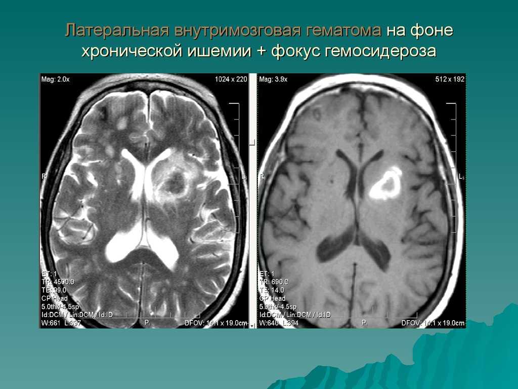 Глиоз головного мозга что это. Кт мозга внутримозговая гематома. Эволюция внутримозговой гематомы на мрт.