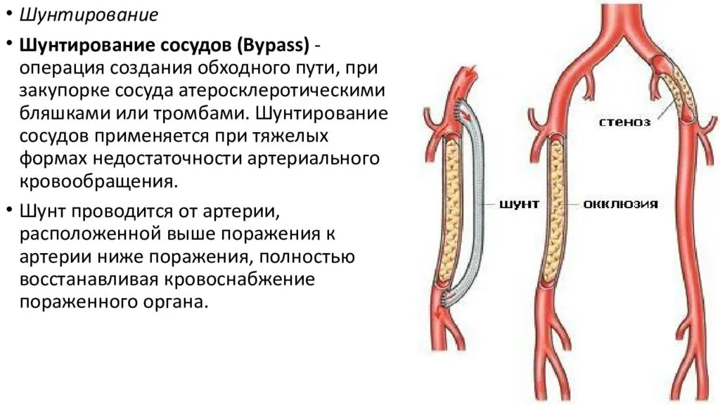 Операция шунтирование ног. Шунтирование артериального сосуда. Шунтирование внутренней сонной артерии. Операция шунтирование артерий нижних конечностей. Шунтирование при атеросклерозе сосудов.