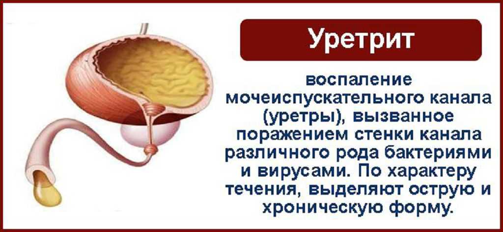 Уреаплазмоз у женщин: что это за заболевание и как его лечить