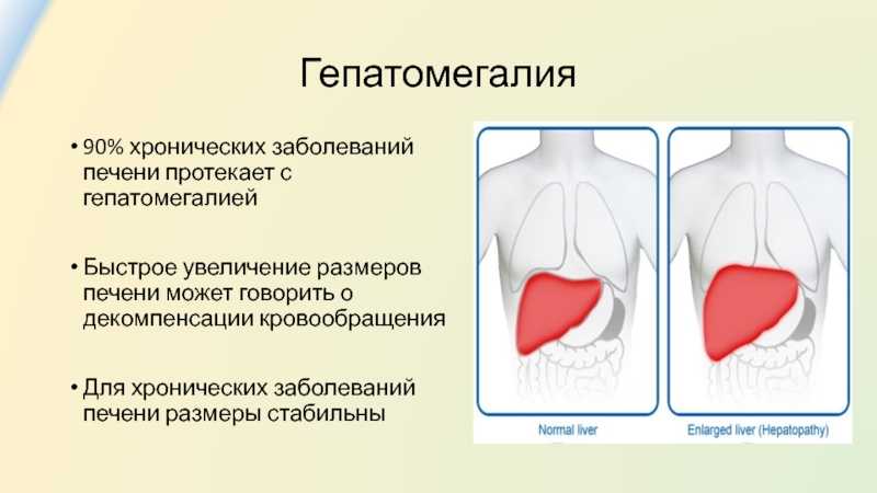 Гепатомегалия печени что это и как лечить. Гепатомегалия. Гепатомегалия Размеры печени. Гепатомегалии печени что это такое. Увеличение размеров печени.