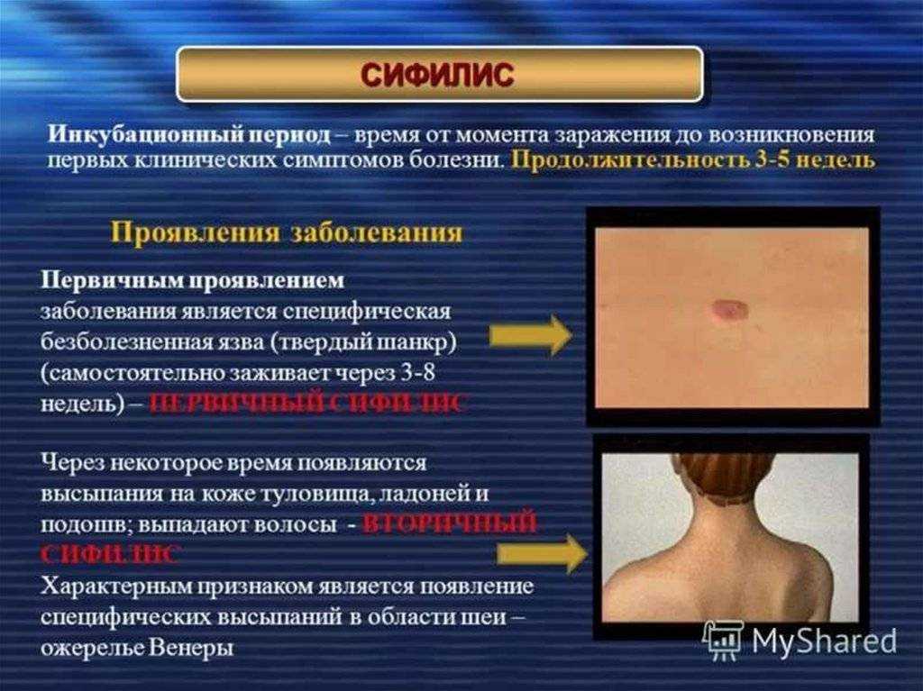 Красный плоский лишай