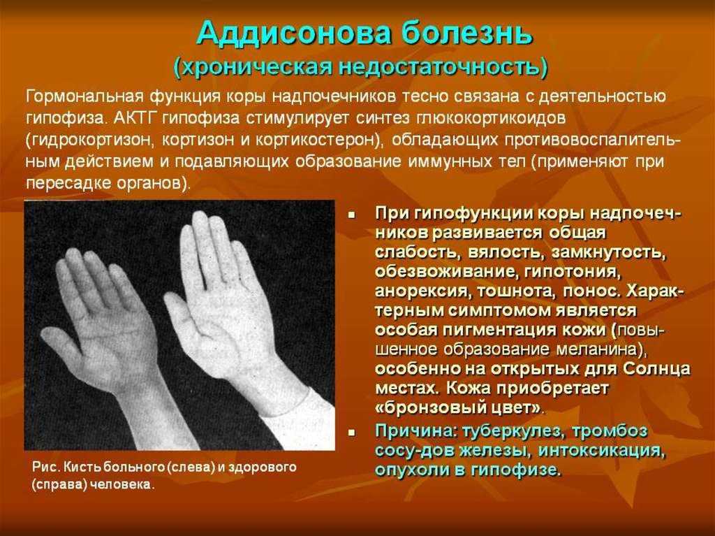 Аддисонический криз или острая недостаточность коры надпочечников!