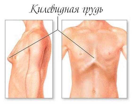 Деформация грудной клетки, деформация позвоночника | eurolab | травматология