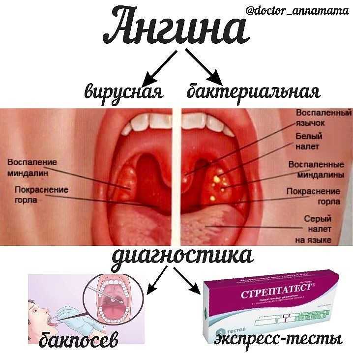 Куф при тонзиллите схема