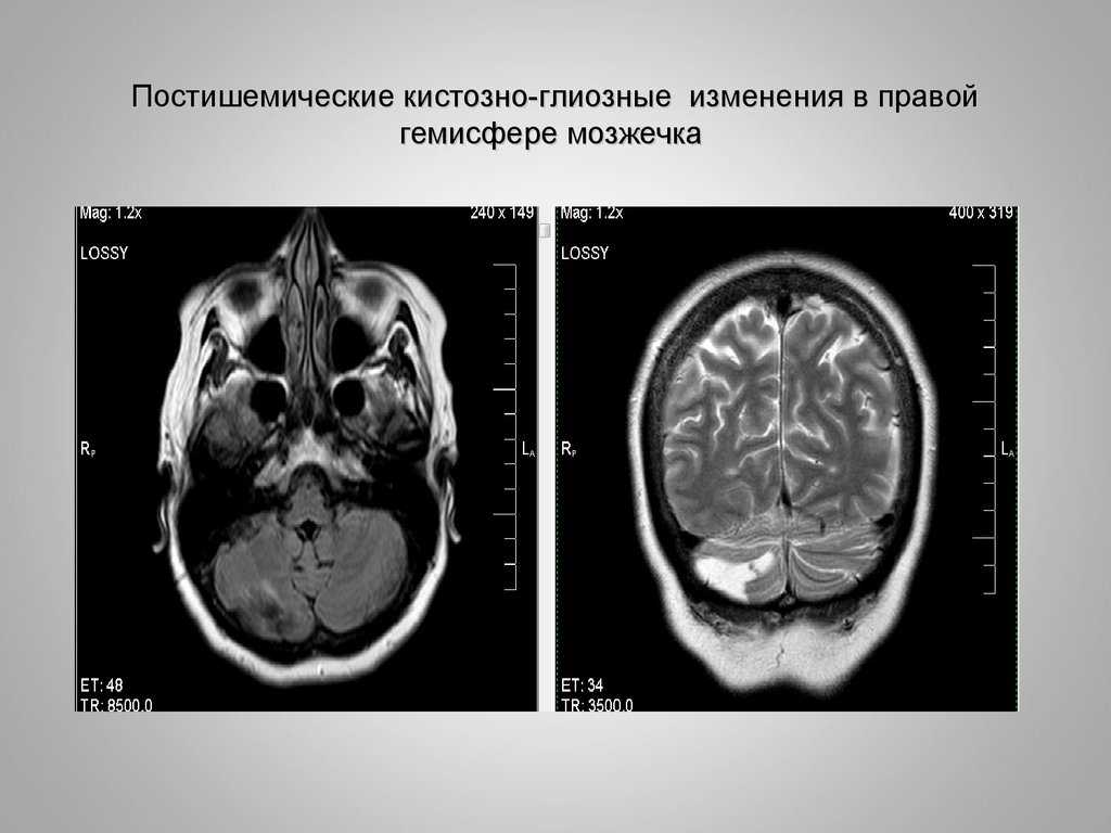 Глиозные изменения белого вещества головного мозга