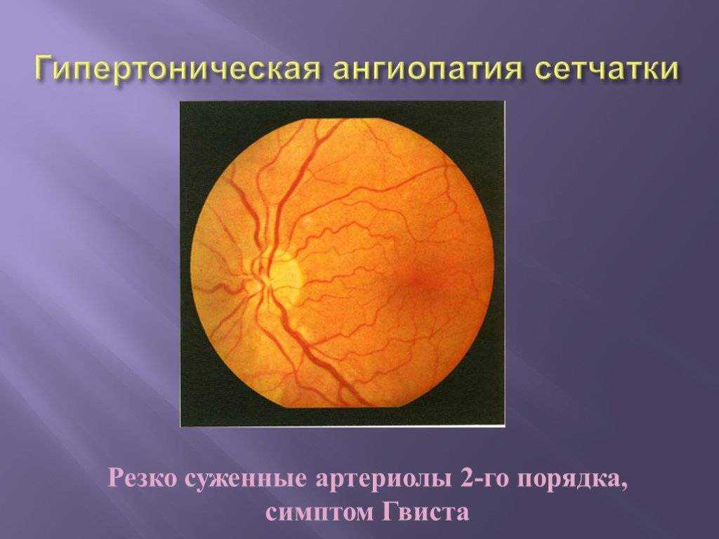 Сетчатки обоих глаз. Гипертоническая ангиопатия сетчатки. Ангиопатия сетчатки глазное дно. Глаза гипертоническая ангиопатия. Клиника гипертонической ангиопатии сетчатки.