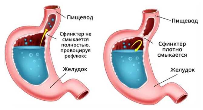 Гастроэзофагельная рефлюксная болезнь - что это