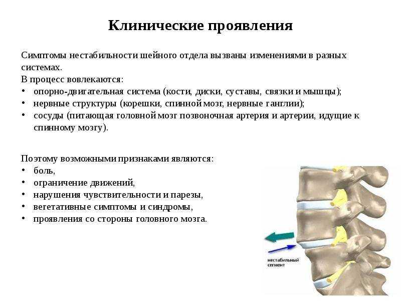 Нестабильность позвоночно-двигательного сегмента - лечение, симптомы, причины, диагностика | центр дикуля