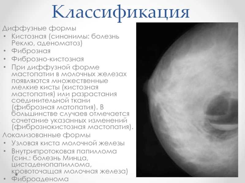 Эффективное лечение серозного мастита у женщин
