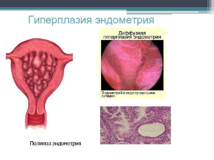 Слизистая матки. Гиперплазия эндометрия доброкачественное заболевание. Ультраменструальная гиперплазия эндометрия что это. Полиповидная гиперплазия эндометрия. Невыраженная гиперплазия эндометрия.