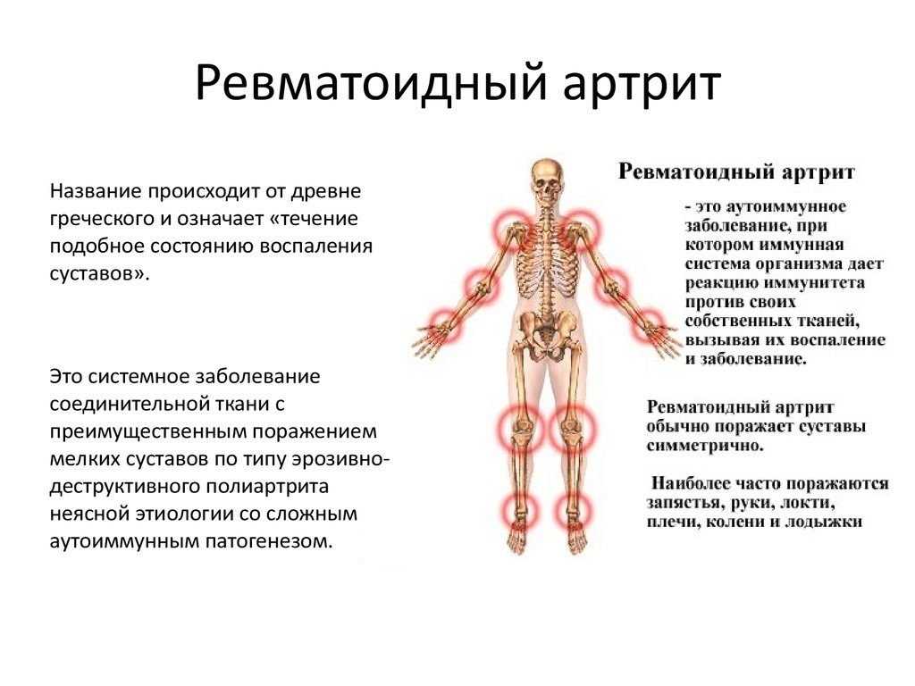 Схема лечения артрита у взрослых