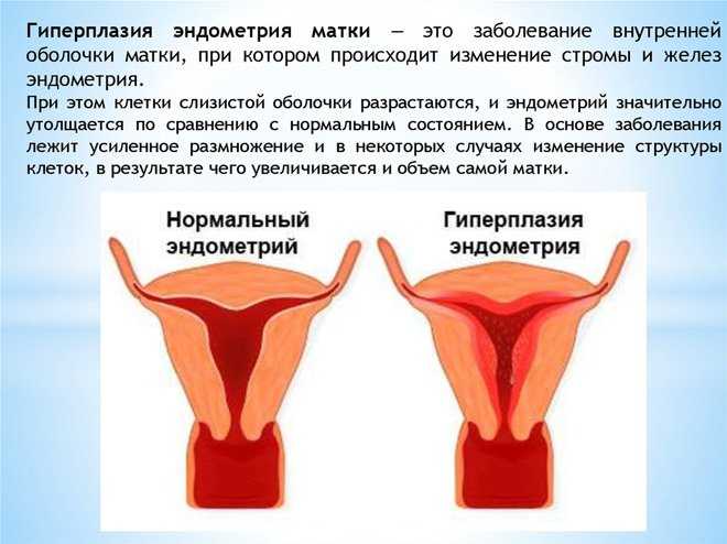 Гиперплазия эндометрия — причины появления, способы лечения, формы и виды