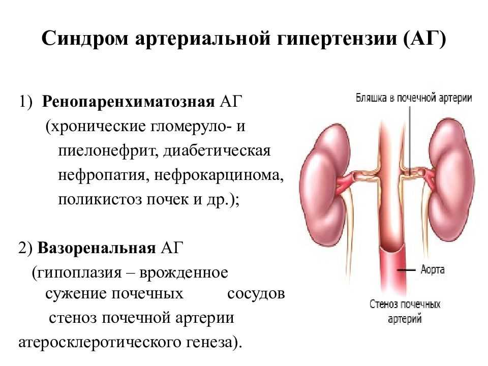 Синдром почечной артериальной гипертензии пропедевтика. Синдром почечной гипертензии пропедевтика. Синдром артериальной гипертензии при хроническом пиелонефрите. Синдром артериальной гипертонии симптомы.