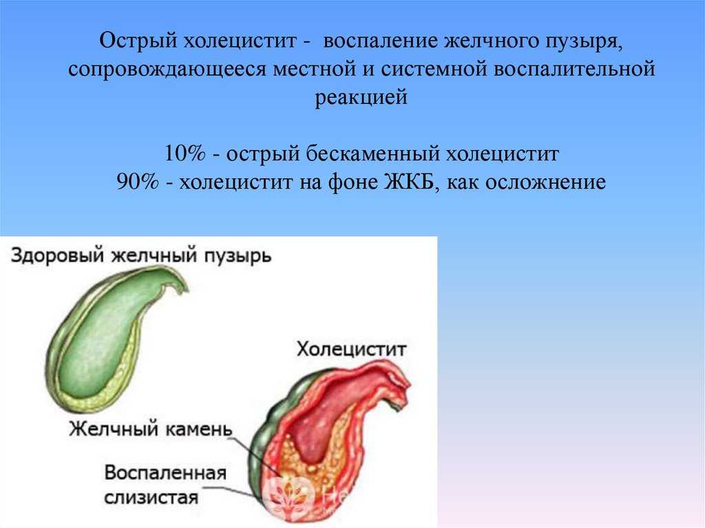 Воспаление желчного пузыря