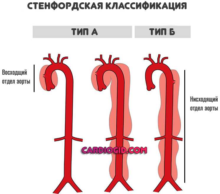 Аневризма аорты