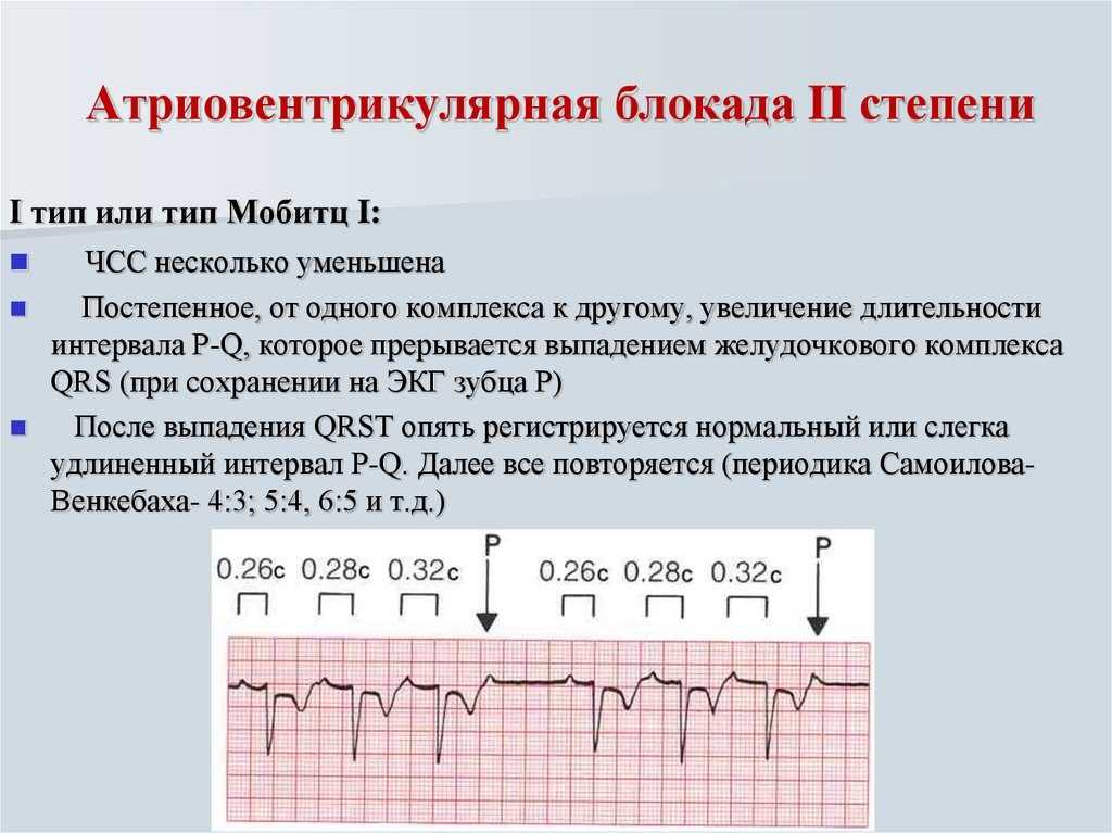 Нарушения проводимости сердца