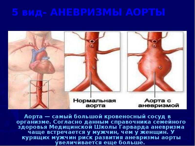 Заболевание периферических артерий и вен: тромбозы, варикоз, аневризмы | симптомы, профилактика, лечение