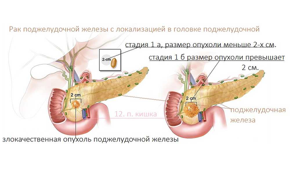 Операция головки поджелудочной железы